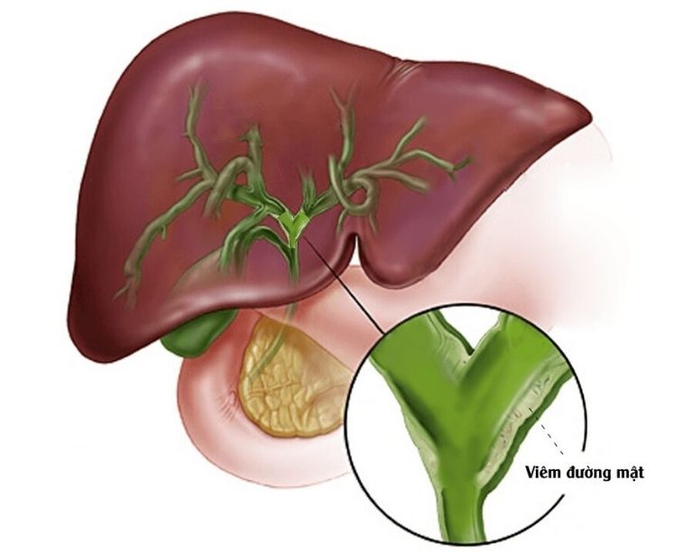 Biến chứng của sỏi mật gây viêm đường mật