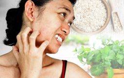 Top 10+ cách trị ngứa da mặt tại nhà hiệu quả, an toàn, dễ áp dụng