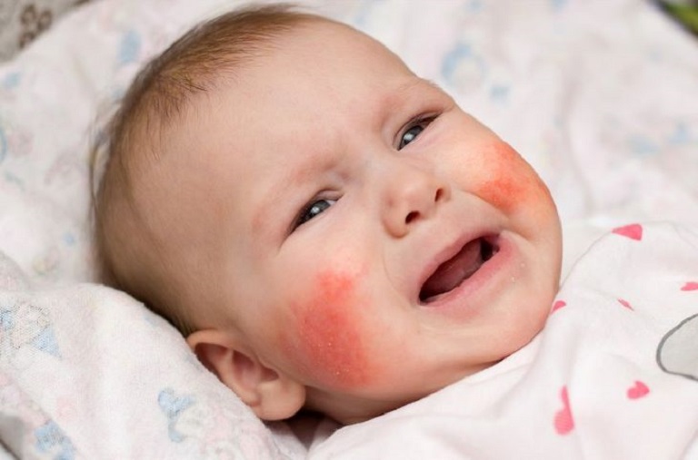 Trẻ nhỏ là đối tượng dễ mắc Cholinergic nhất do làn da và sức đề kháng yếu