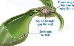 Sỏi đường mật: Nguyên nhân, biến chứng và cách điều trị hiệu quả