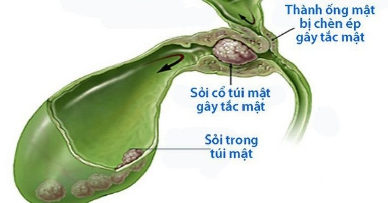 Có nhiều nguyên nhân gây sỏi đường mật