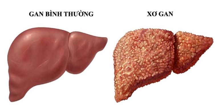 3. Triệu Chứng Của Suy Gan Giai Đoạn Cuối