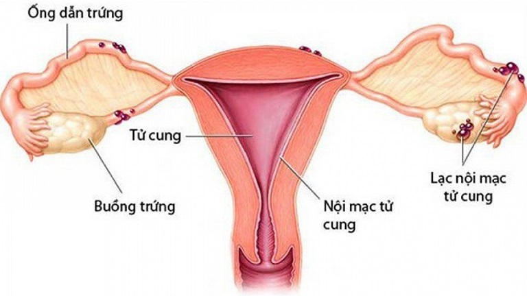 Nội mạc tử cung là lớp niêm mạc bao phủ mặt trong thành tử cung