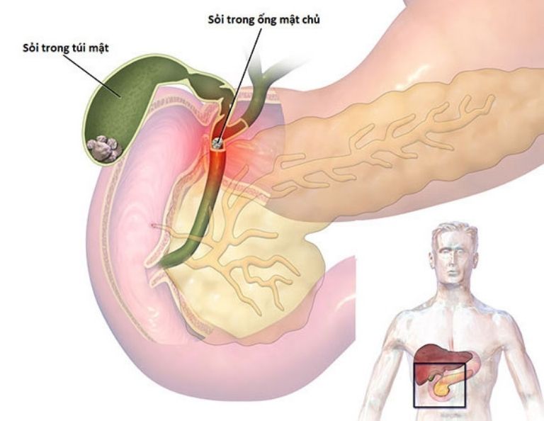 Sỏi đường mật nằm ở nhiều vị trí trong hệ thống đường dẫn mật