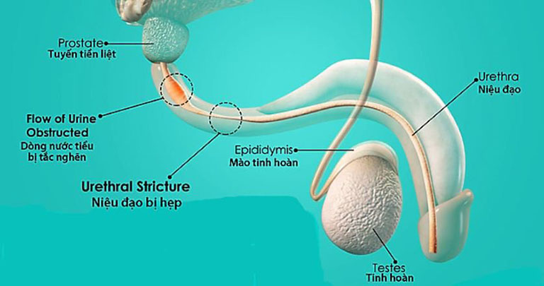 Hẹp niệu đạo khiến bệnh nhân tiểu buốt tiểu rắt