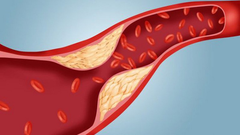 Cholesterol cao là bệnh lý gây nguy hiểm nghiêm trọng tới sức khỏe