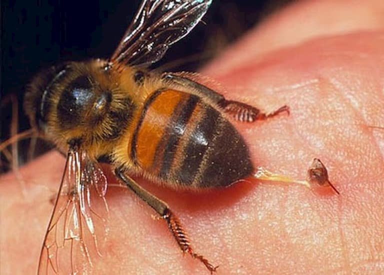 Ong châm là biện pháp y tế được áp dụng từ lâu