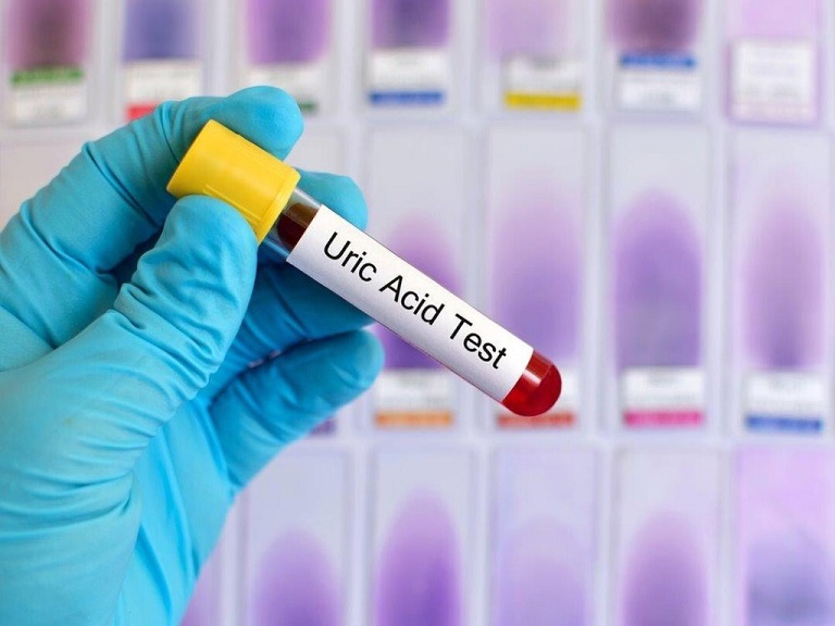 Xét nghiệm acid uric định kỳ giúp bảo vệ sức khỏe