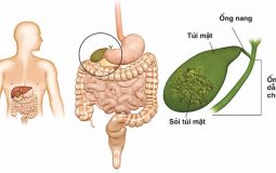 Sỏi mật có nguy hiểm không? 5 biến chứng sỏi mật ít người biết