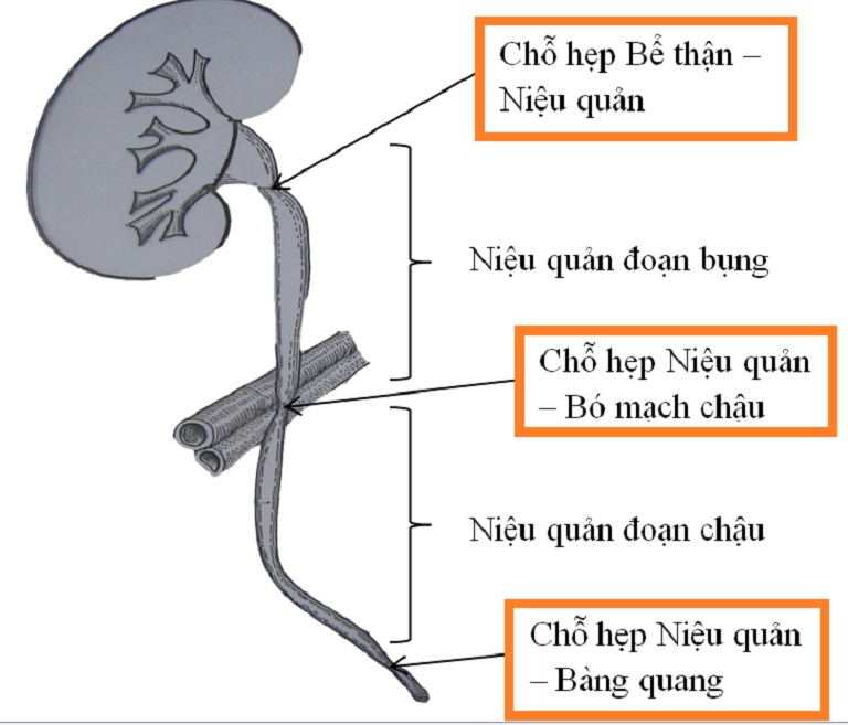 Tán sỏi bàng quang bằng laser không được chỉ định cho bệnh nhân có niệu quản hẹp, gấp khúc, dị dạng thận