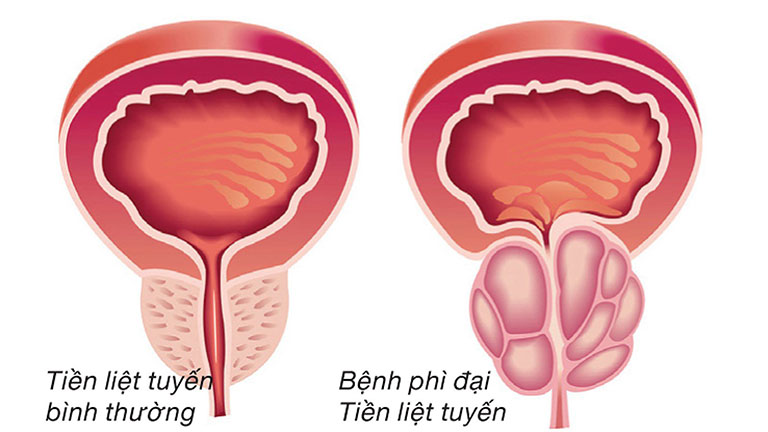 Hình ảnh mô phỏng tăng sản tuyến tiền liệt