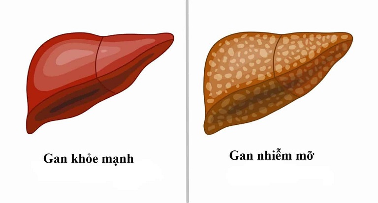 Triglycerid cao dẫn đến gan nhiễm mỡ, suy giảm chức năng gan