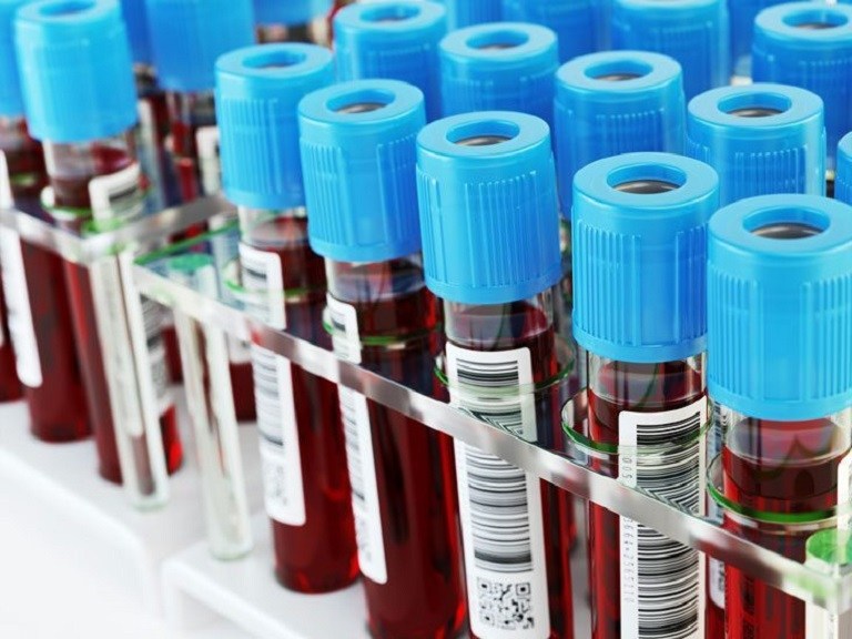 Xét nghiệm Amylase máu là kỹ thuật được sử dụng rất thường xuyên giúp phát hiện các tình trạng của bệnh viêm tụy cấp