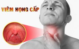 Viêm họng cấp ở người lớn: Dấu hiệu cảnh báo và cách điều trị dứt điểm