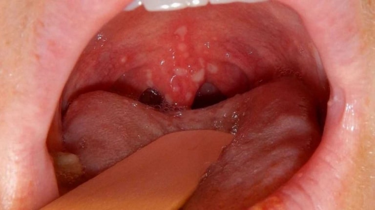 Viêm họng hốc mủ có thể biến chứng thành ung thư vòm họng