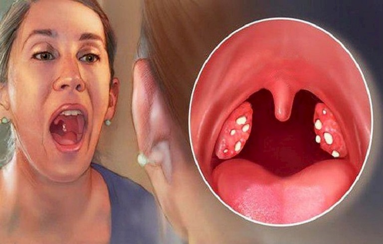 Đau họng kéo dài thuộc dạng bệnh lý mãn tính
