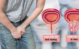 Chữa Viêm Tiền Liệt Tuyến Ở Đâu Hiệu Quả? Top Địa Chỉ Uy Tín Nhất