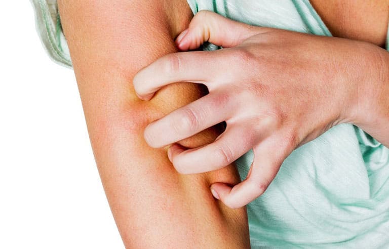 Khi bị ngứa người bệnh không nên dùng tay gãi sẽ khiến vùng da viêm tổn thương sâu, khó điều trị