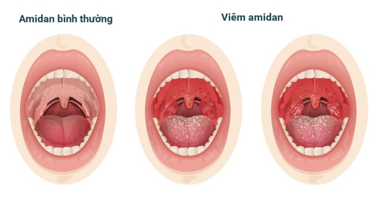 Amidan bình thường và amidan bị viêm có biểu hiện hình thái trái ngược nhau