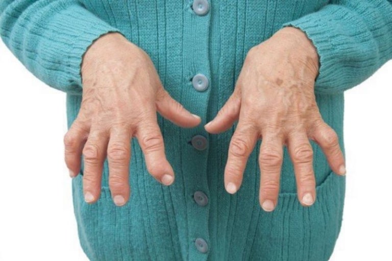 Các dấu hiệu nhận biết bệnh viêm khớp ngón tay như đau, sưng, cứng khớp, nóng đỏ da, biến dạng khớp