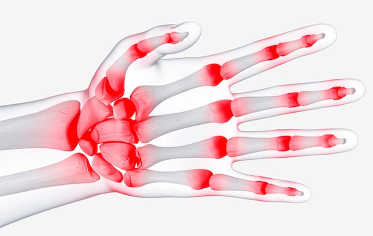 Viêm xương khớp có thể gây ra tình trạng sưng đau khớp tay