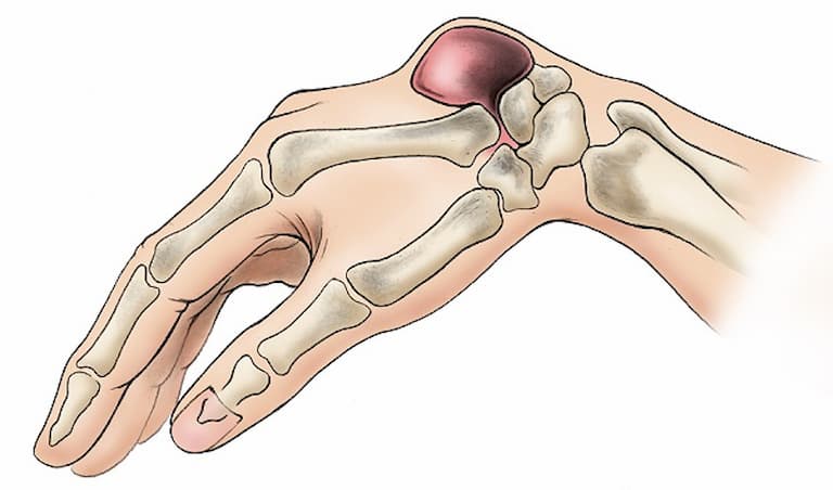 10. Chế độ ăn uống và dinh dưỡng cho người bị viêm bao hoạt dịch khớp cổ tay