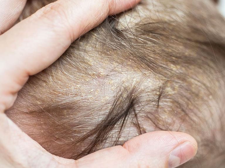Viêm da tiết bã da đầu hình thành do tuyến nhờn hoạt động mạnh