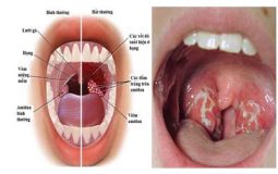 Bị amidan nên làm gì để nhanh khỏi? Khuyến nghị từ chuyên gia y tế