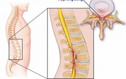 Hẹp ống sống là bệnh gì? Nguyên nhân, điều trị và cách phòng tránh