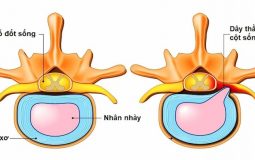 Phồng đĩa đệm là gì? Tìm hiểu dấu hiệu bệnh và cách chữa khỏi hoàn toàn