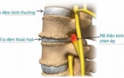 Thoái hóa đĩa đệm: Dấu hiệu bệnh và cách điều trị hiệu quả