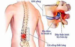 Thoát vị đĩa đệm cột sống thắt lưng: Nguyên nhân và cách điều trị hiệu quả