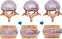 Thoát vị nội xốp: Dấu hiệu bệnh và các biện pháp điều trị