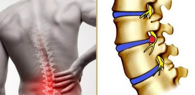 Phồng đĩa đệm l4-l5: Mức độ nguy hiểm và cách điều trị