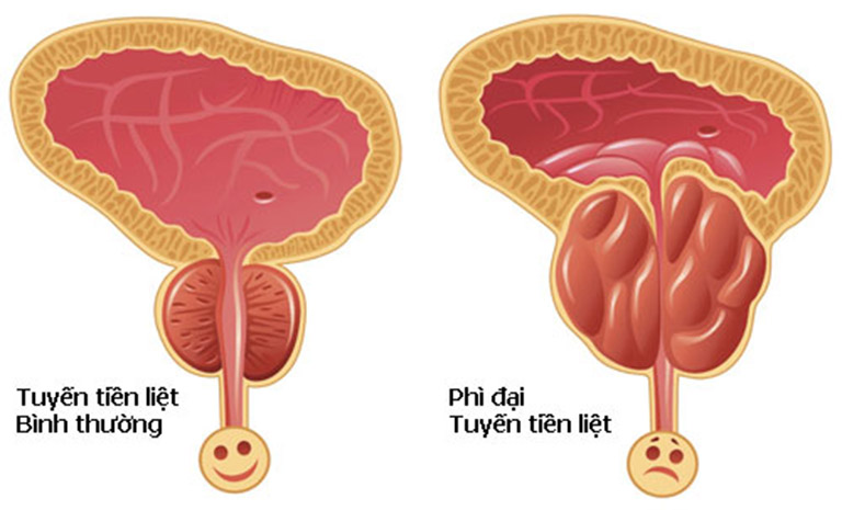 Tuyến tiền liệt khi bị phì đại sẽ ảnh hưởng tới khả năng tiểu tiện của nam giới