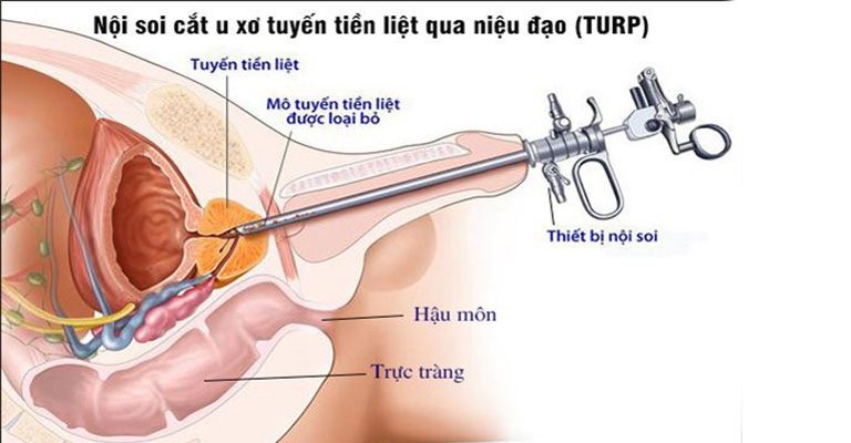 Mổ nội soi để cắt u xơ qua niệu đạo (TURP)