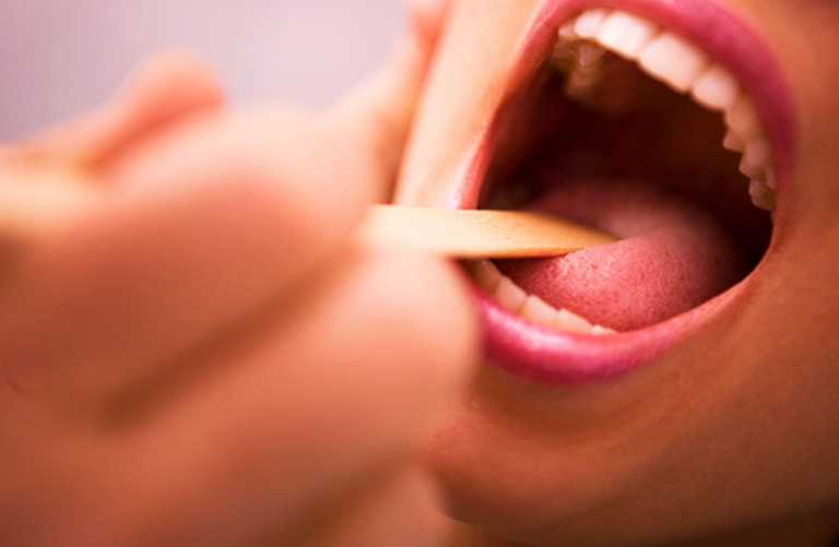Nếu bạn có triệu chứng đau rát họng thì có thể bạn đã bị viêm amidan cấp tính.