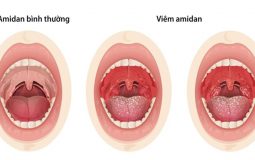 Viêm amidan ở người lớn là gì? Nguyên nhân và cách điều trị