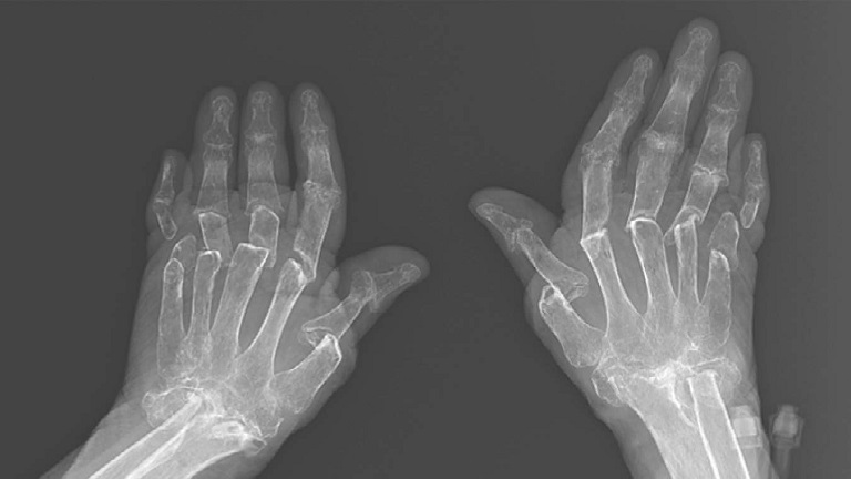 Tiêu chuẩn chẩn đoán viêm khớp dạng thấp thông qua phim chụp X-quang