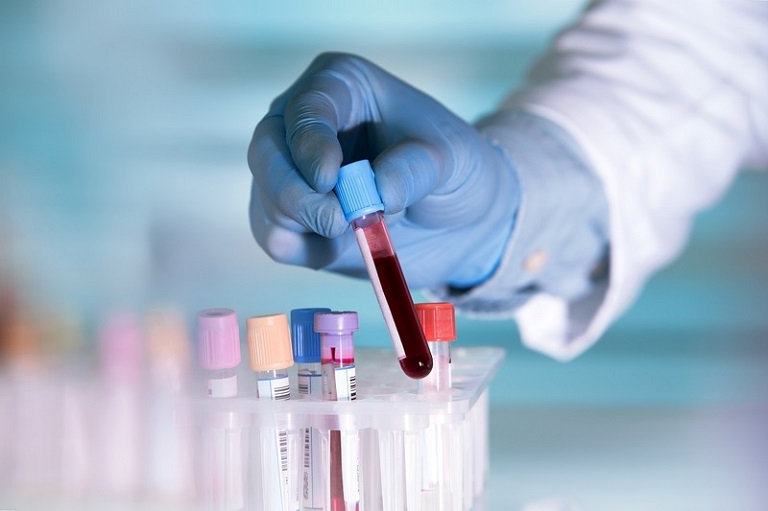 Xét nghiệm máu giúp đánh giá bệnh viêm khớp dạng thấp