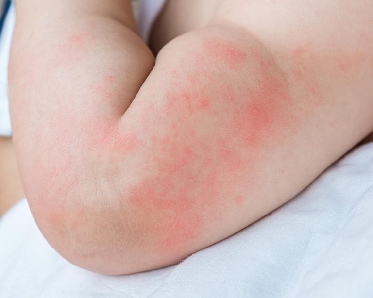 Những nốt mẩn ngứa khiến trẻ thường vô thức gãi làm tổn thương da, có thể gây nhiễm trùng