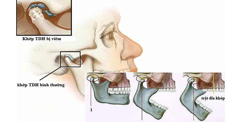 Khớp thái dương hàm bình thường và khớp bị viêm đau