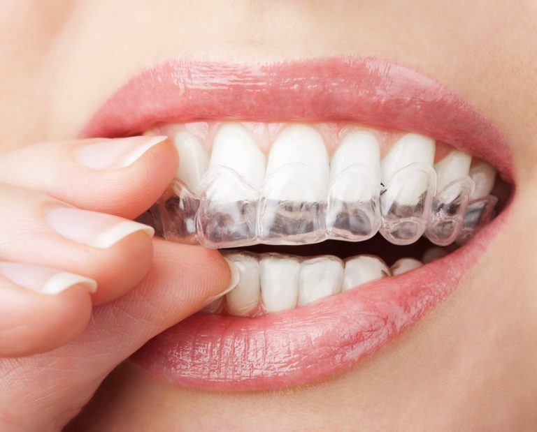 Lựa chọn phương pháp niềng răng phù hợp sẽ giúp bạn gia tăng hiệu quả chỉnh nha