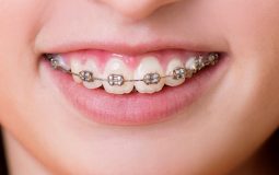 Chi phí niềng răng hô hàm