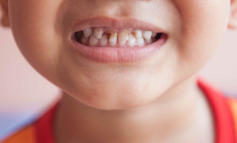 Sâu răng, viêm lợi là nguyên nhân điển hình gây ra tình trạng đau răng ở trẻ nhỏ
