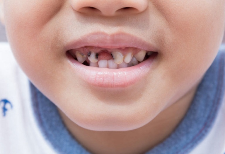 Đau nhức răng do sâu có thể khiến bé bị mất răng sớm nếu không được điều trị kịp thời