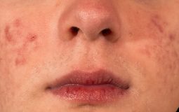Da mặt khô ngứa mẩn đỏ: Thông tin quan trọng cần biết