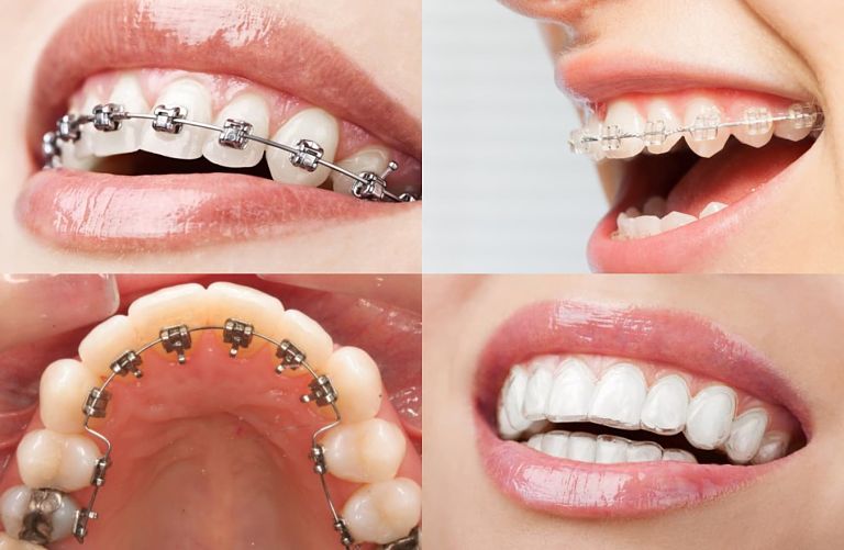 Phương pháp niềng răng là yếu tố quyết định giá niềng răng