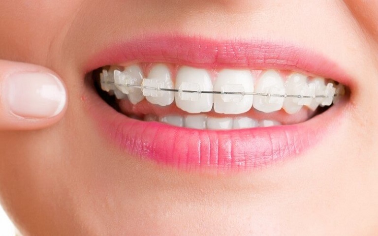 Mức giá niềng răng mắc cài sứ sẽ phụ thuộc vào tình trạng răng của bạn