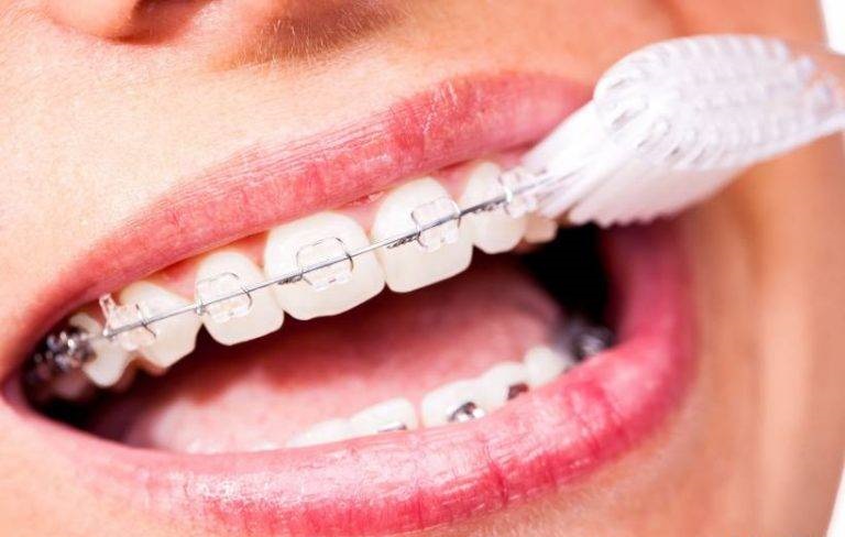 Để tránh bị các vấn đề răng miệng sau khi niềng, bạn nên vệ sinh răng một cách cẩn thận 